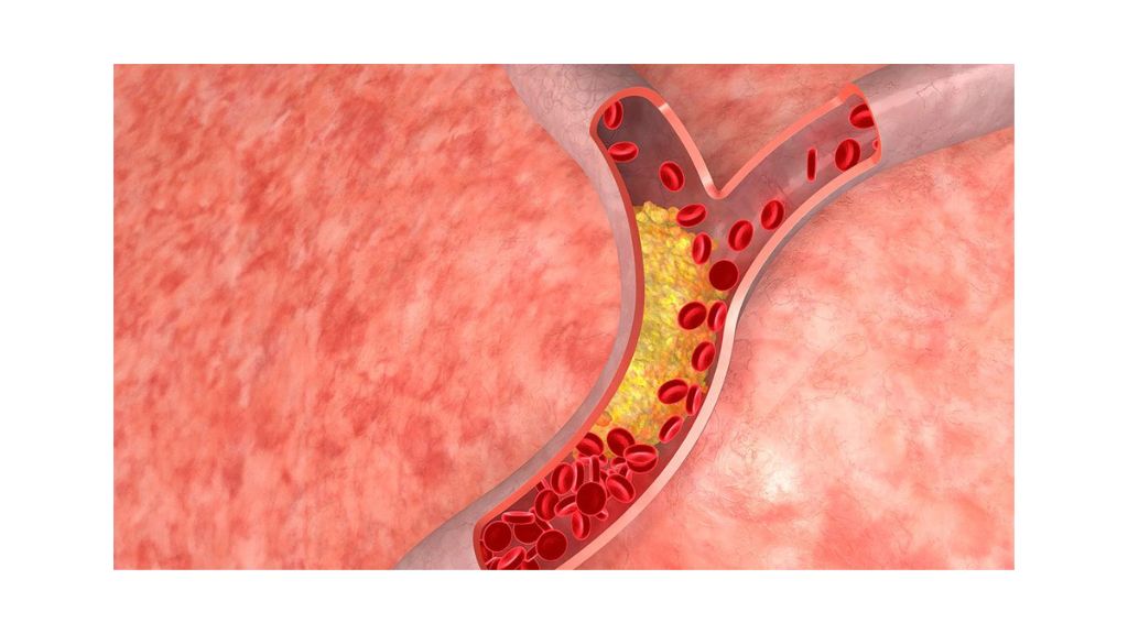 5 Foods to Avoid If You Have High Cholesterol